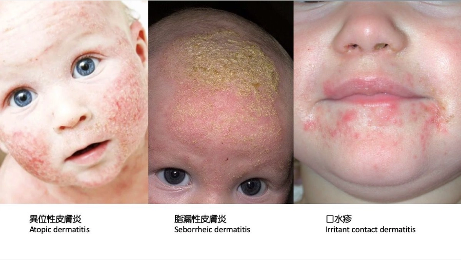 小嬰兒：異位性皮膚炎、脂漏性皮膚炎、口水疹