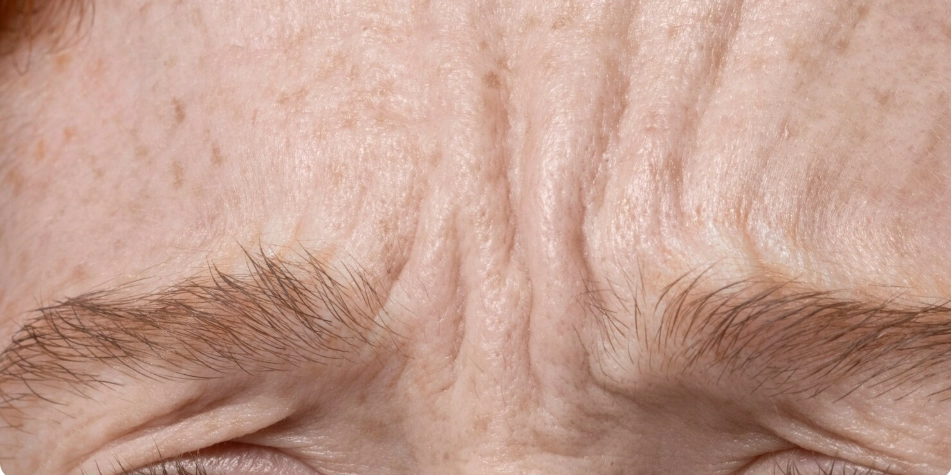 皮膚老化導致川字紋