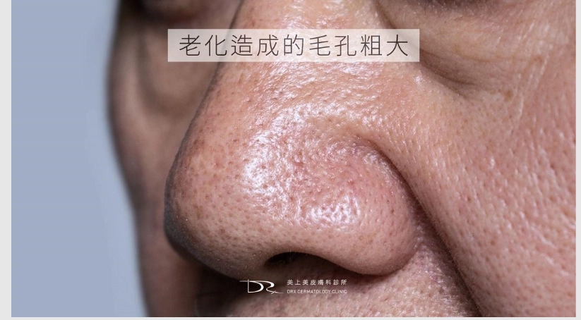 老化型毛孔粗大