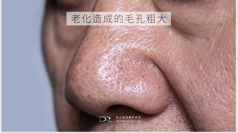 老化型毛孔粗大