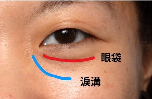 淚溝和眼袋經常被搞混，一張圖讓你分辨。