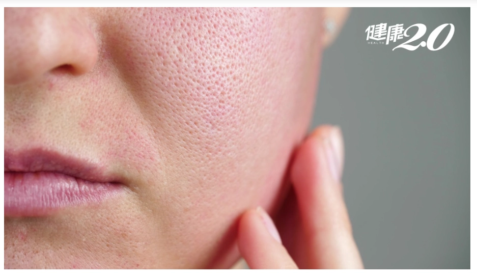 乾燥老廢型毛孔粗大