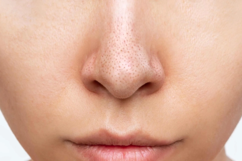 毛孔粗大T字部位