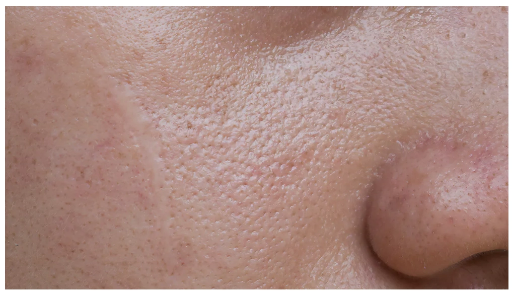 油脂型毛孔粗大