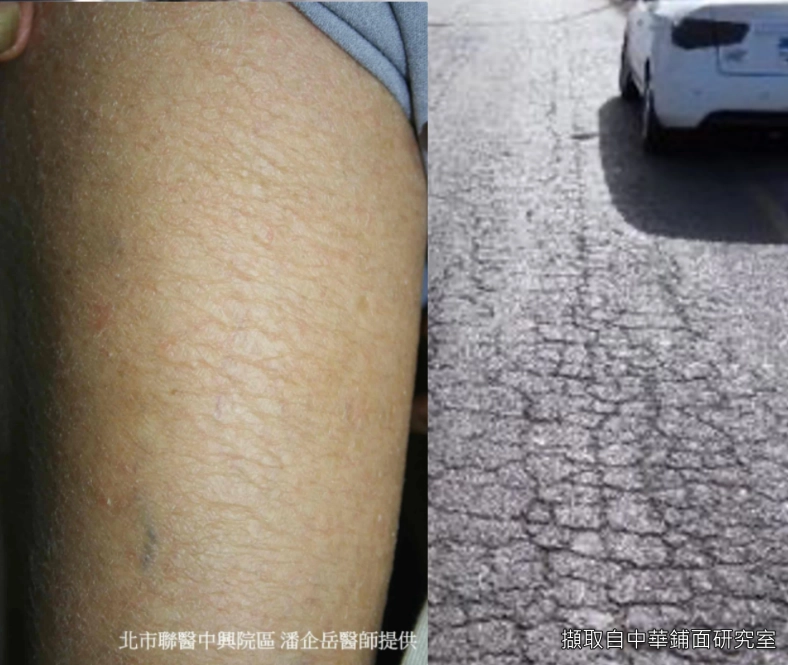 冬季濕疹皮膚狀態