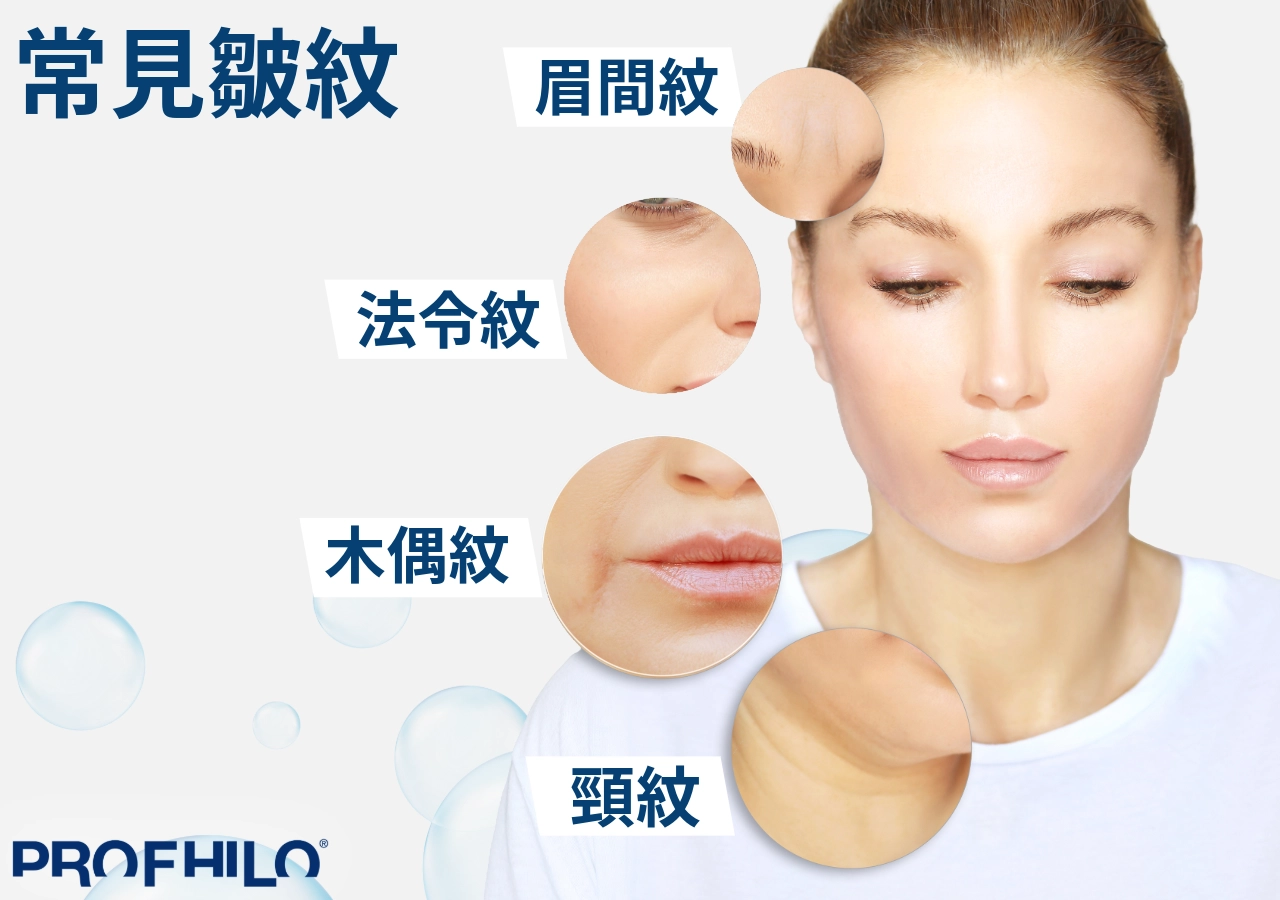 常見皺紋