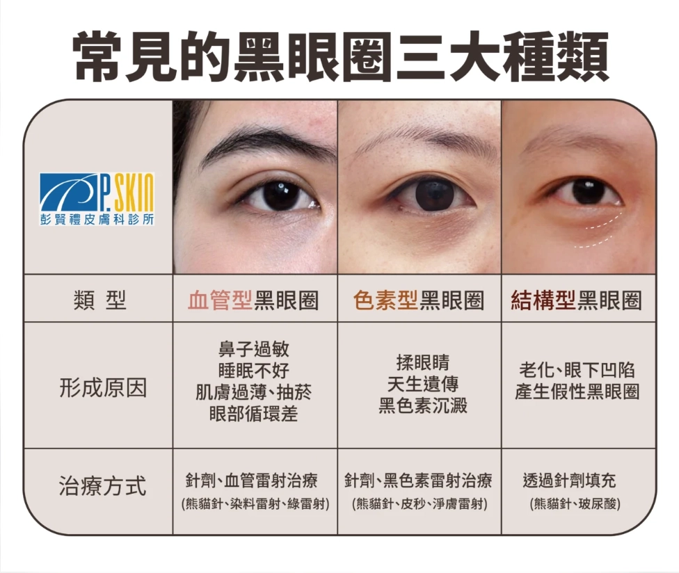 彭賢禮皮膚科診所：常見的黑眼圈三大種類