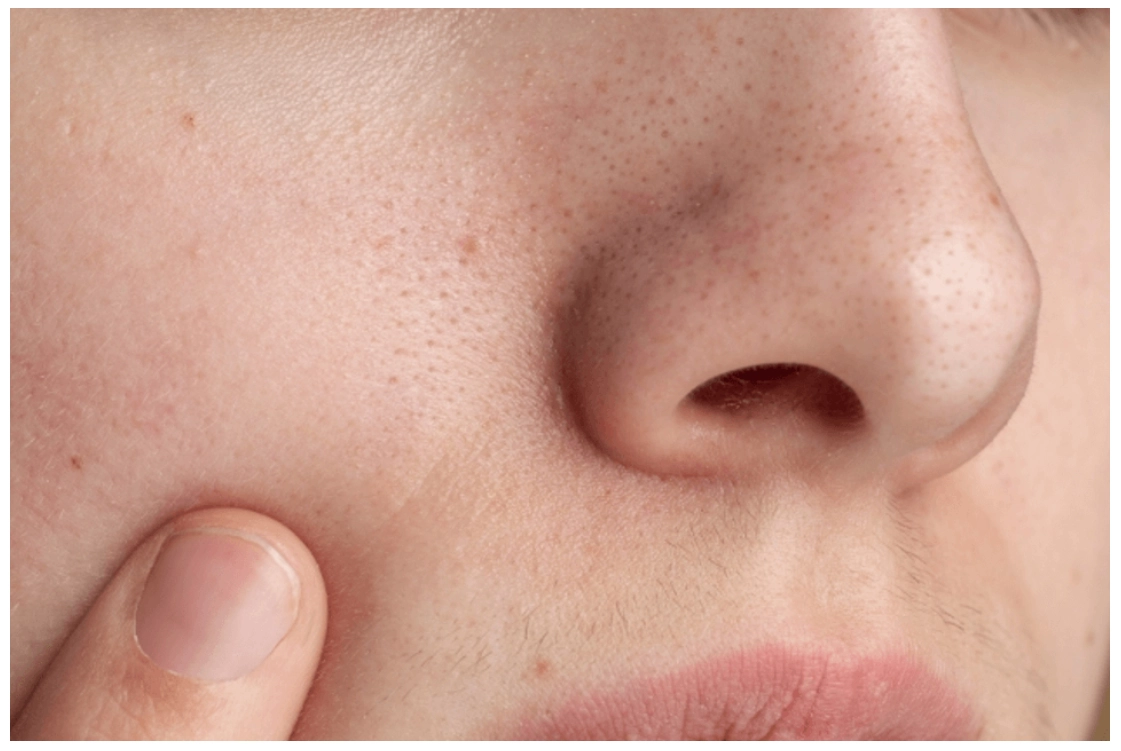 皮脂肪管絲毛孔粗大