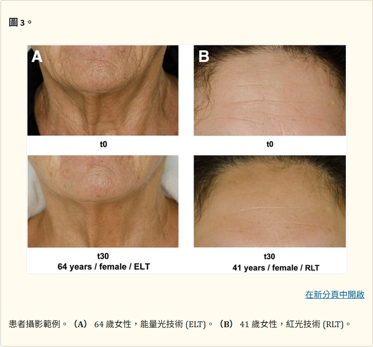 患者攝影範例。（A） 64 歲女性，能量光技術 (ELT)。（B） 41 歲女性，紅光技術 (RLT)。