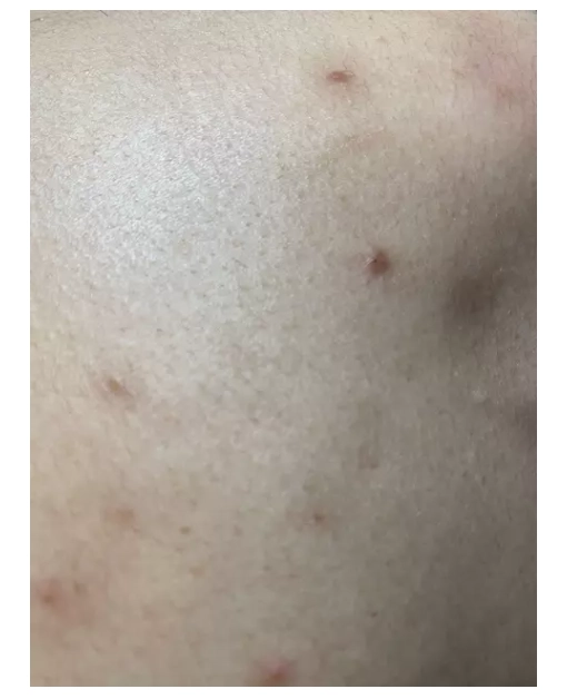 背部痘痘毛孔粗大