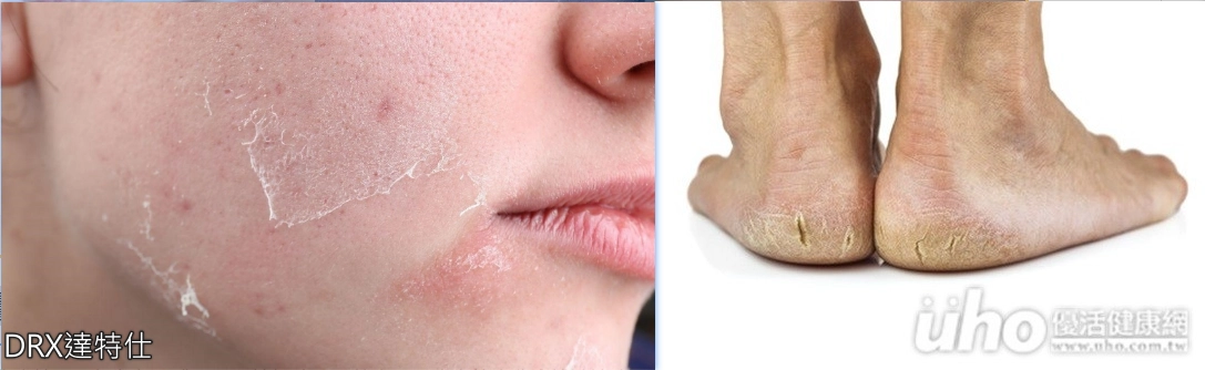 皮膚乾裂圖
