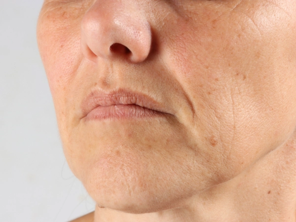 不笑也看得到、陰影很明顯的法令紋