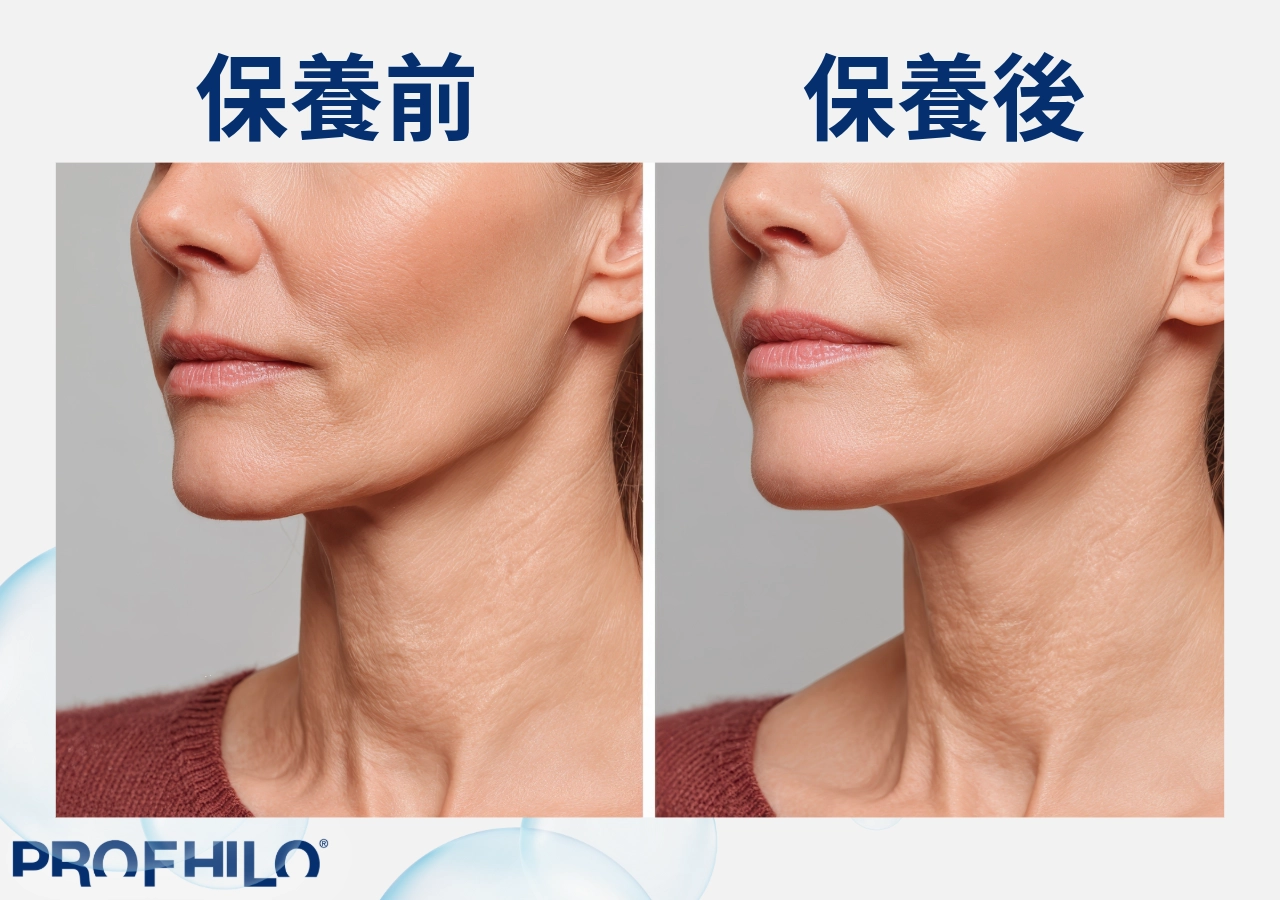 法令紋保養前後對比